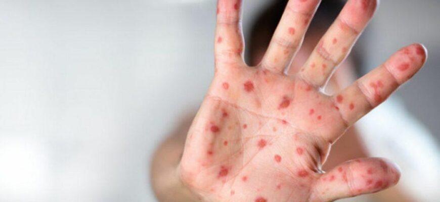 prevention of measlesjpg
