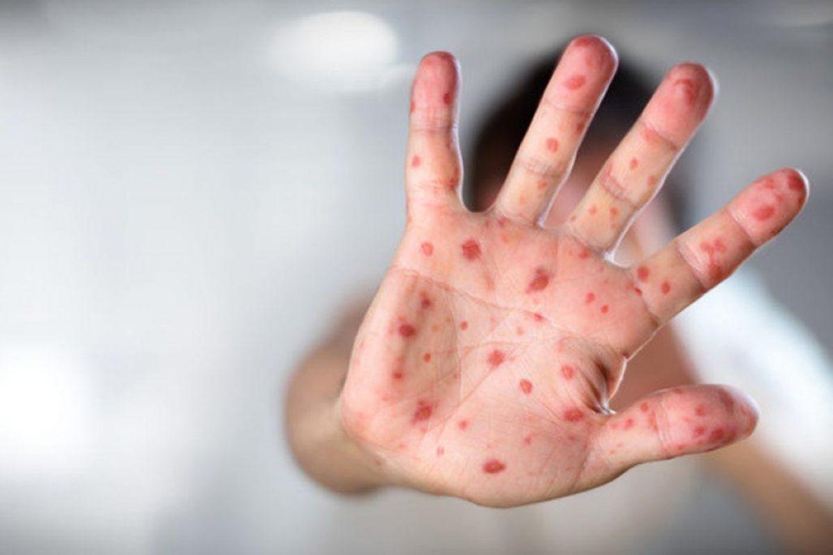 prevention of measlesjpg